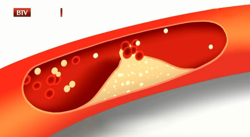 眼角血脂斑怎么消除,眼角长什么说明血脂高
