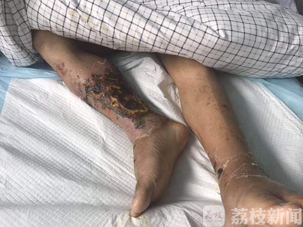 皮皮虾被割伤事件,一男子被虾刺伤