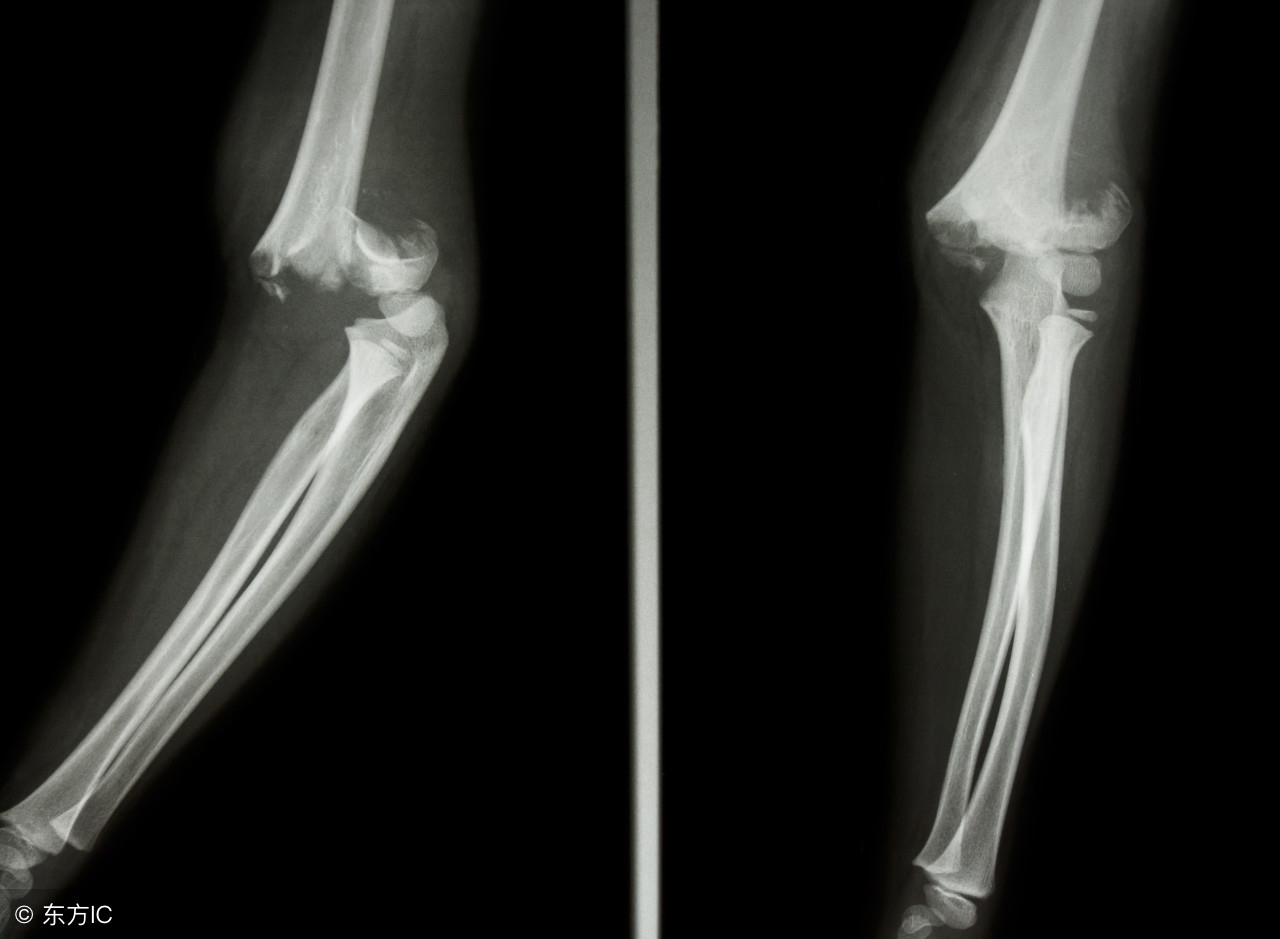 骨折手术后复位注意什么,掌骨骨折手法复位后多久能愈合