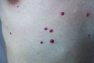 身上红痣怎么治疗,身上长红痣什么原因