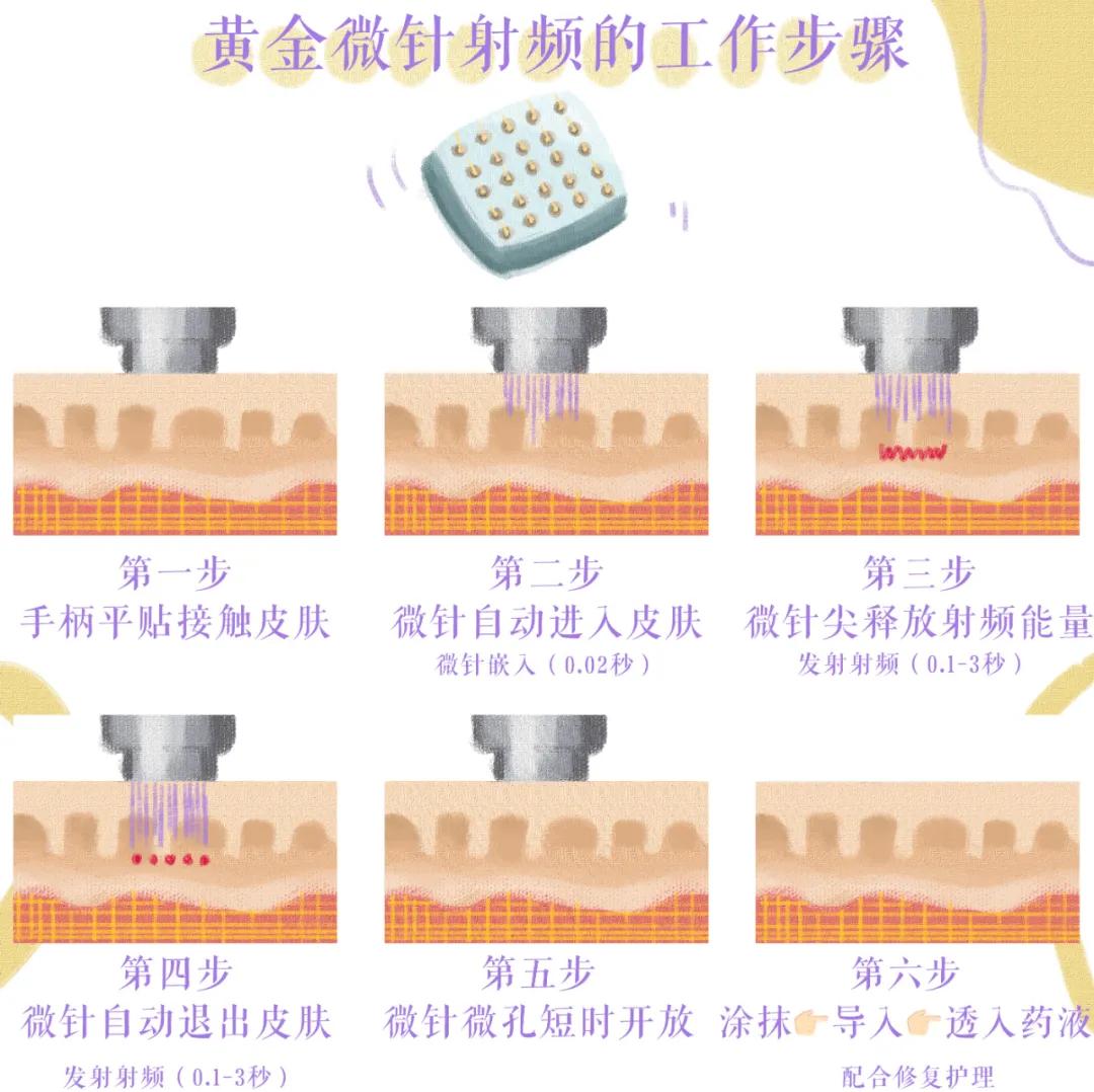 大痘印适合做什么医美,医美做什么可以去除痘坑