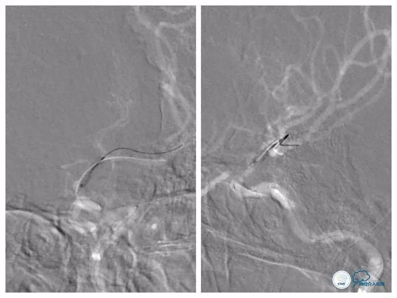 颈内动脉c5到c7段狭窄微创手术,天坛医院住院日记