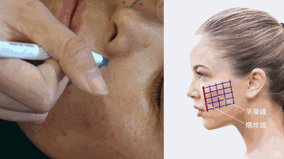 有法令纹很显老怎么办,法令纹木偶纹哪个显老