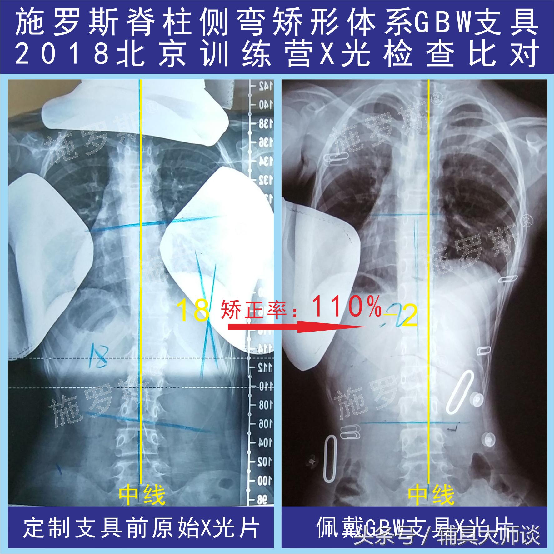 德国gbw支具侧弯60度适合吗,德国gbw支具北京哪里可以订