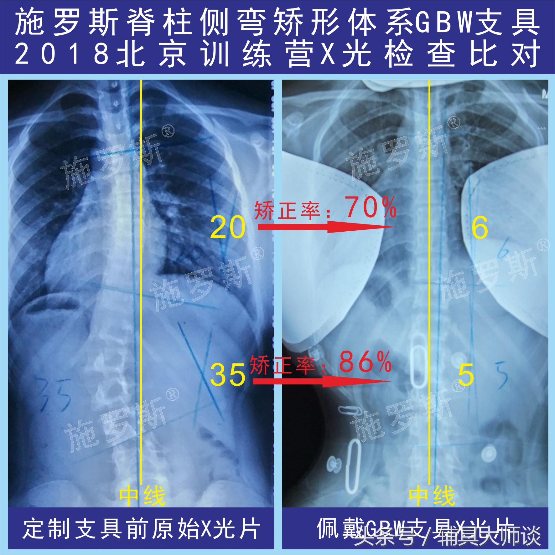 德国gbw支具侧弯60度适合吗,德国gbw支具北京哪里可以订