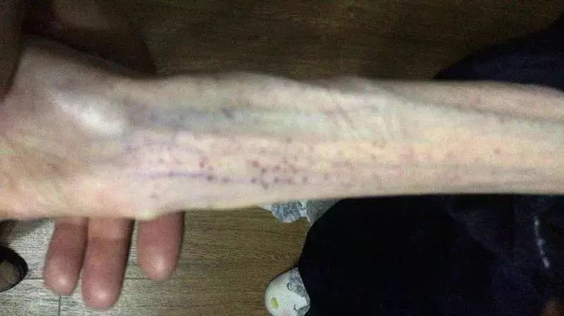 21岁女孩自杀式减肥，1米67只有50斤！照片不忍直视！