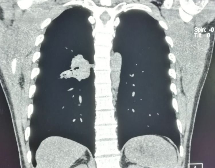 肺癌手术后胸腔内有碎肉怎么办,肺癌切除手术后有个空腔