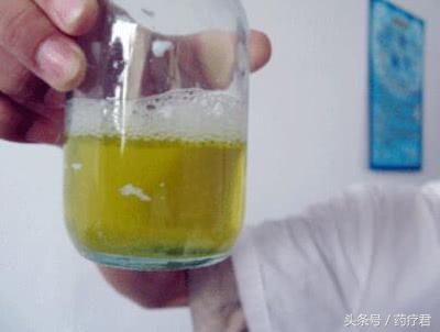 体检蛋白尿2个加号其余没有问题,肾病综合征蛋白尿有几个加号