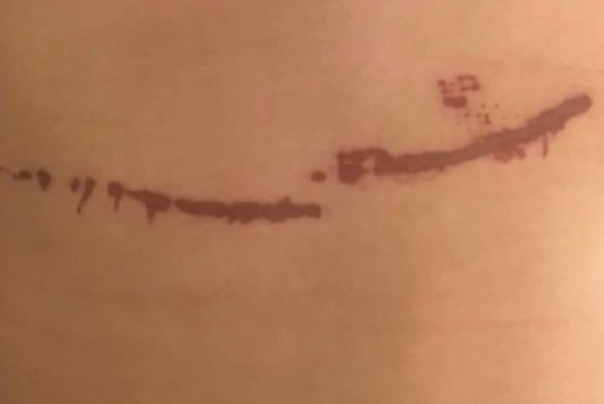 5岁女孩被大面积烫伤,小孩脸冻伤留后遗症