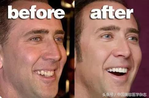 牙齿缝隙太大怎么补救吃什么,牙齿缝隙太大怎么快速补救