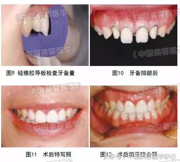 牙齿缝隙太大怎么补救吃什么,牙齿缝隙太大怎么快速补救