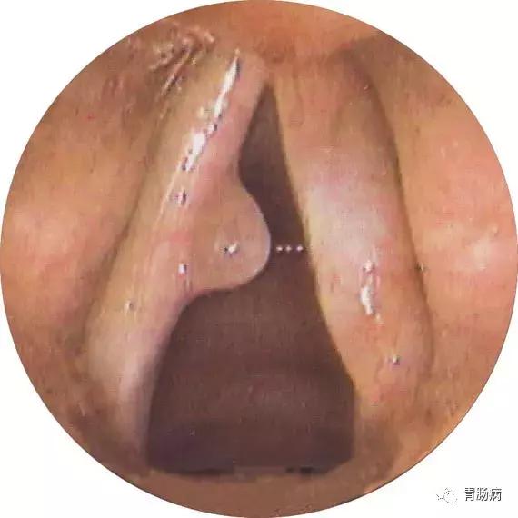 肠息肉切除还是不切除,肠息肉和胆囊息肉必须做手术吗