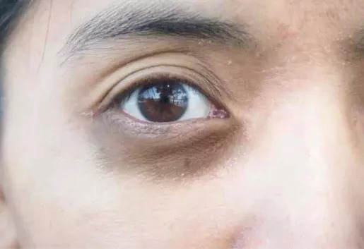 黑眼圈和眼袋总是消不掉怎么办,黑眼圈去不掉是因为没有对症下药