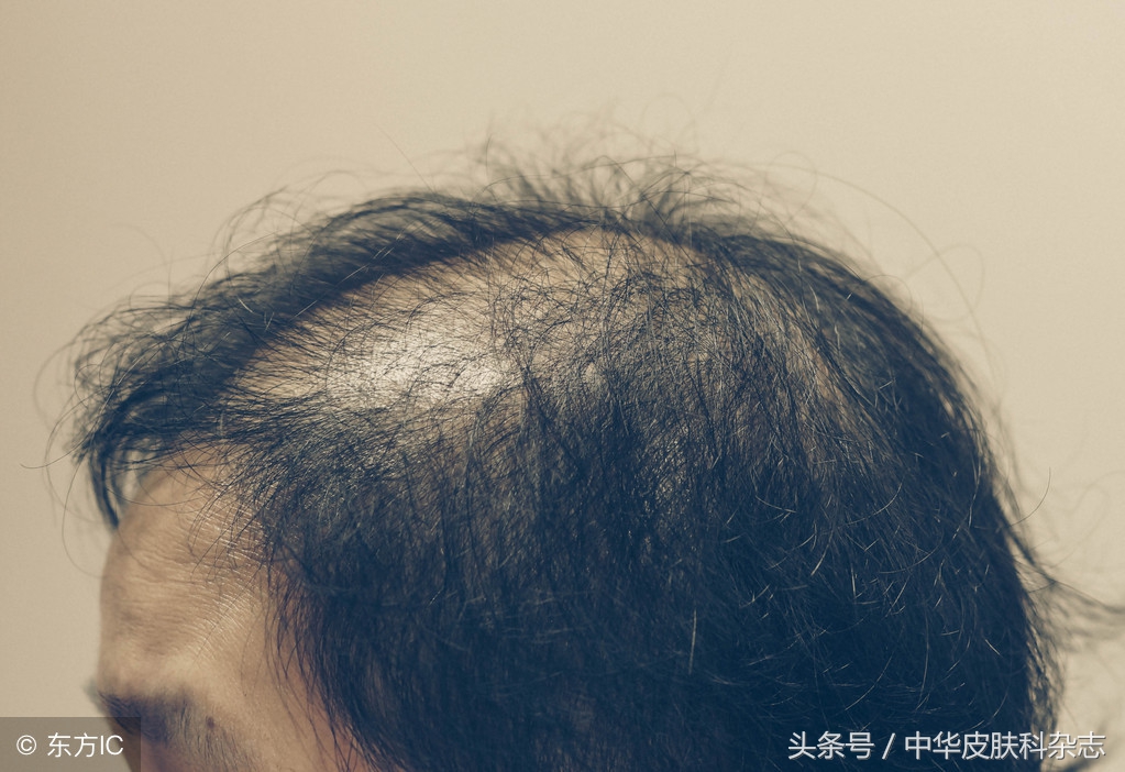 怎么判断脱发还是断发,如何判断是脱发还是掉发