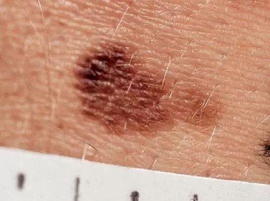 宝宝从小脚上就长黑痣是怎么回事,小孩脚后跟长了颗黑痣越来越大
