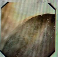 胸水为什么会抽不到,胸水抽了为什么还呼吸困难