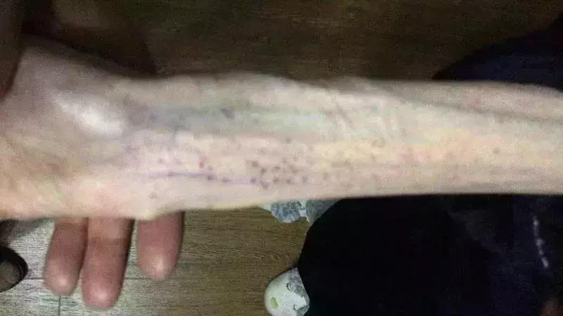 心痛！21岁女孩“自杀式减肥”，照片不忍直视……