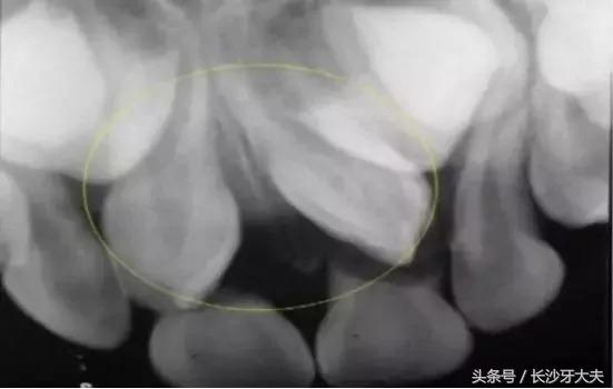 孩子门牙多生牙拔了之后牙缝很大,8岁男童多生牙门牙缝隙大