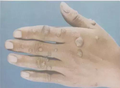 预防宫颈癌从接种hpv疫苗开始,预防宫颈癌需要打针吗