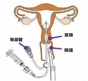 造影新技术,三维超声和x射线输卵管造影