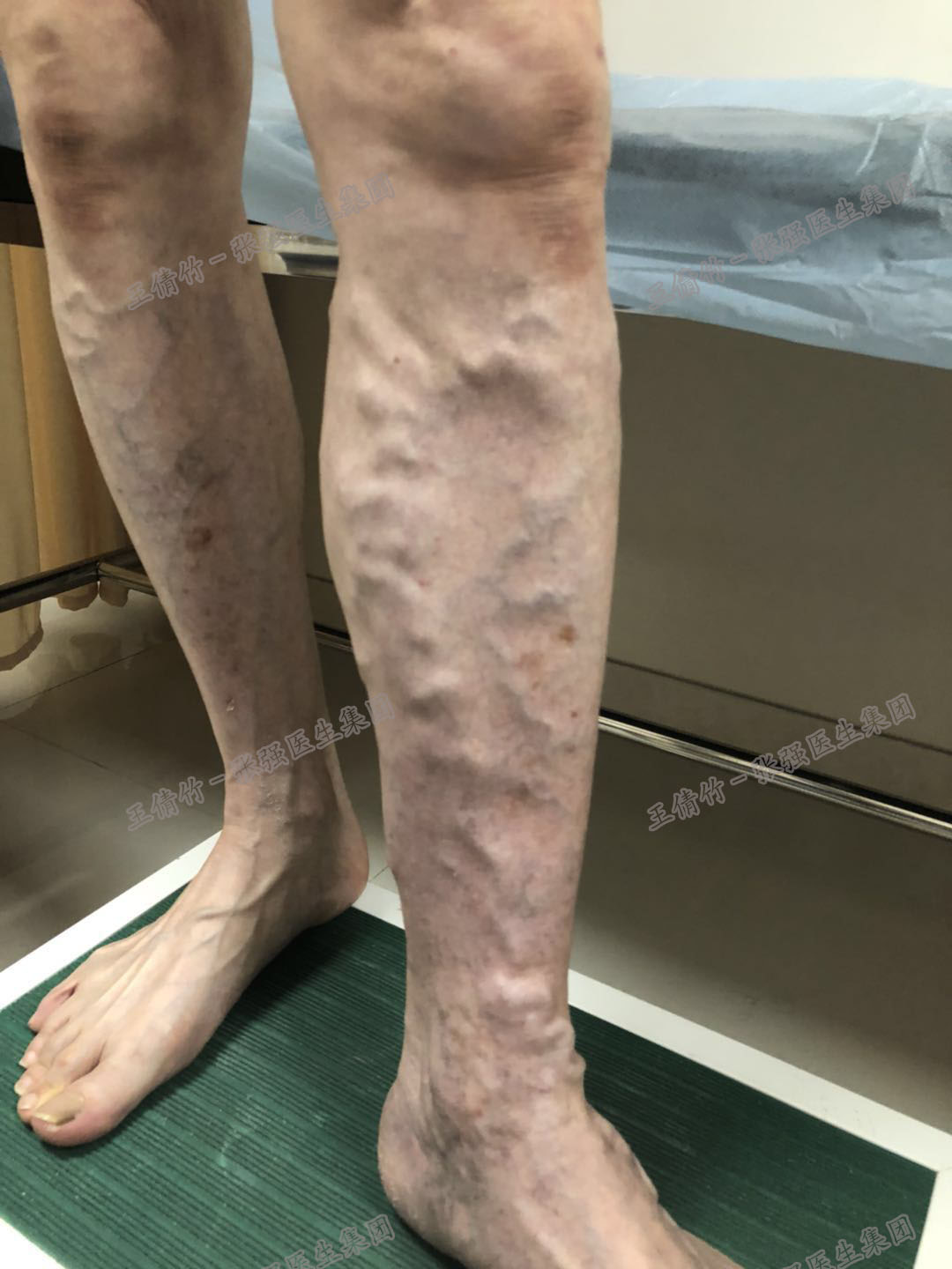 静脉曲张详细解说,静脉曲张知识大全书籍