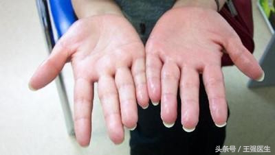 手足冰凉但是老是觉得热,手足冰凉多汗