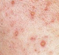 闭口痘痘涂什么药膏医生推荐,闭口粉刺痘痘痘印用什么护肤品