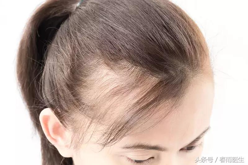 年纪轻轻秃头是啥感受,年纪轻轻就秃头是什么原因