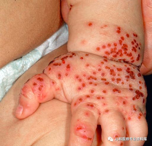 宝宝嘴巴上火的症状,宝宝嘴巴臭是积食还是上火