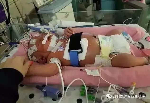 宝宝嘴巴上火了擦什么药膏好,嘴巴上火一圈红怎么办