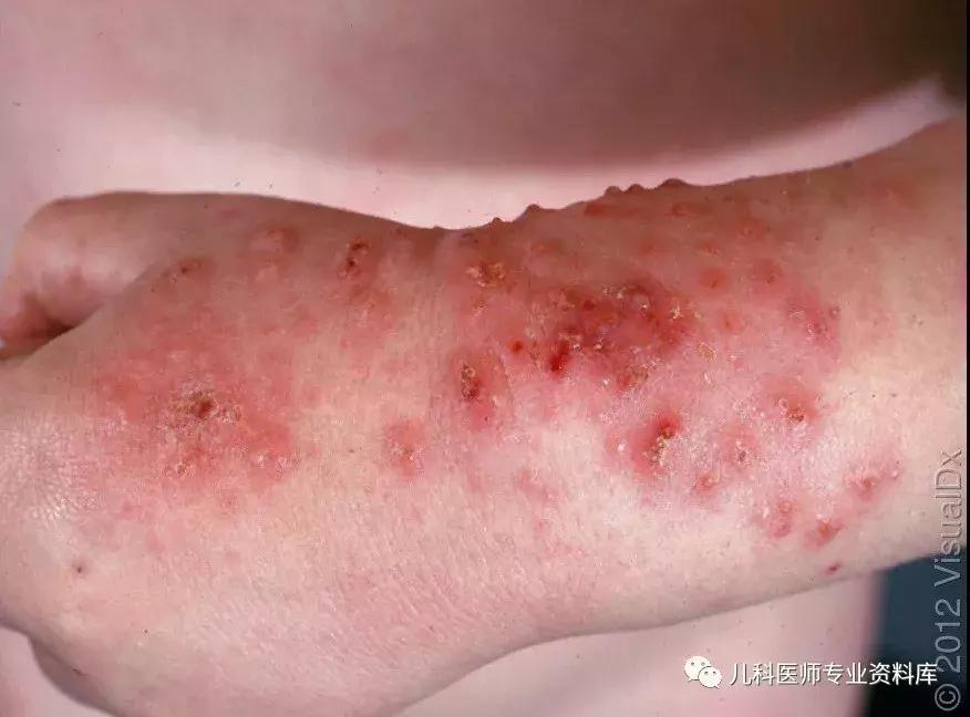 宝宝嘴巴上火了擦什么药膏好,嘴巴上火一圈红怎么办