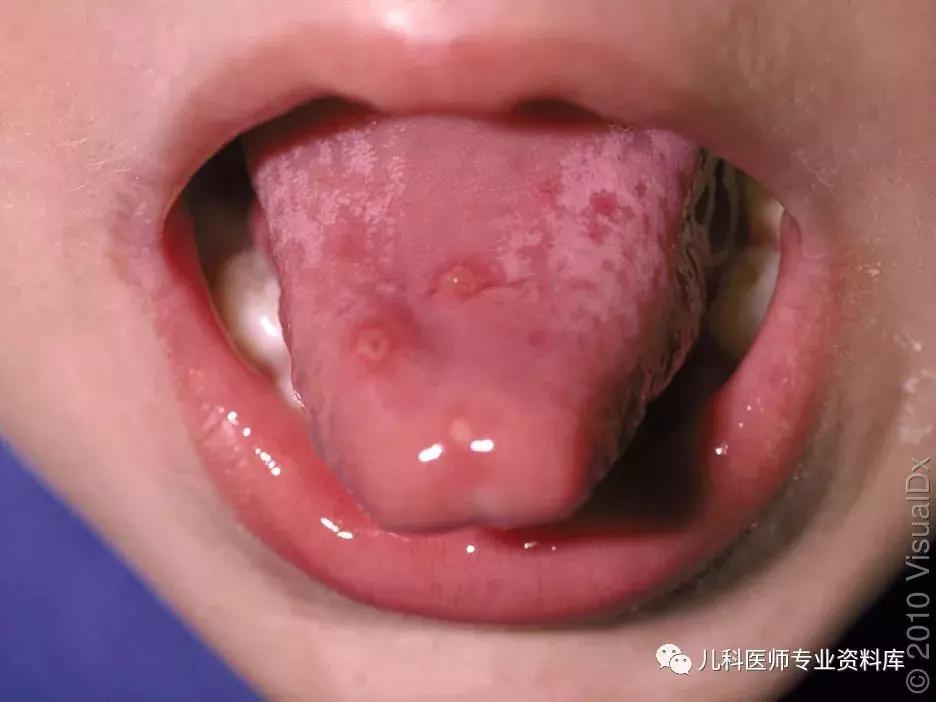 宝宝嘴巴上火了擦什么药膏好,嘴巴上火一圈红怎么办