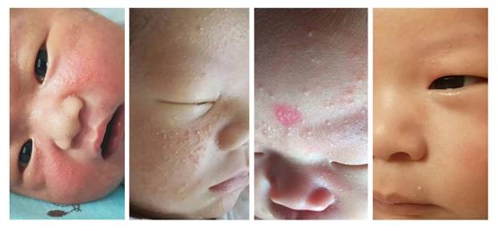 婴儿肌肤总有问题,远离宝宝肌肤问题