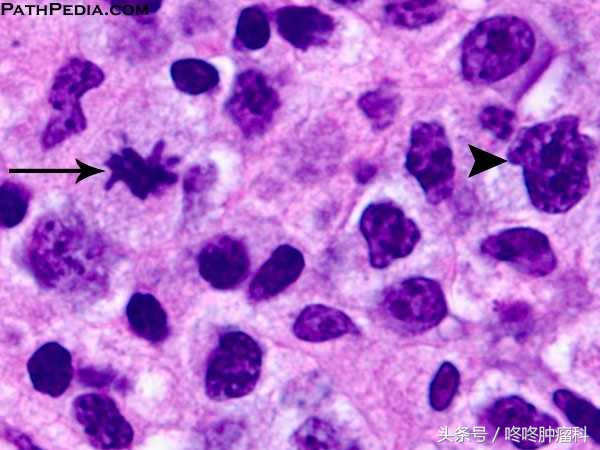 pd-1治疗复发弥漫大b细胞淋巴瘤,pd-1治疗nkt淋巴瘤有效吗