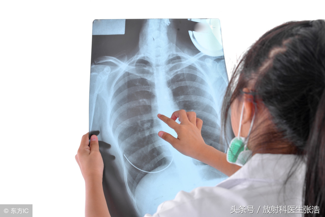 恶性胸腔积液诊断与治疗专家共识,有胸腔积液是结核性胸膜炎吗