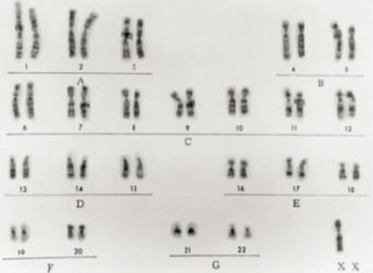 怎么规避turner综合征,turner综合征吃什么