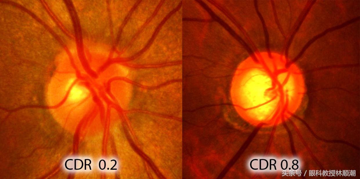 乱滴眼药水的危害,眼药水别滴多