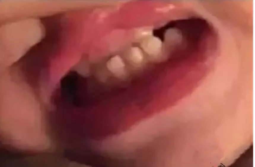 几岁的儿童牙齿就烂了是什么原因,宝宝牙齿烂光了只剩下牙根怎么办