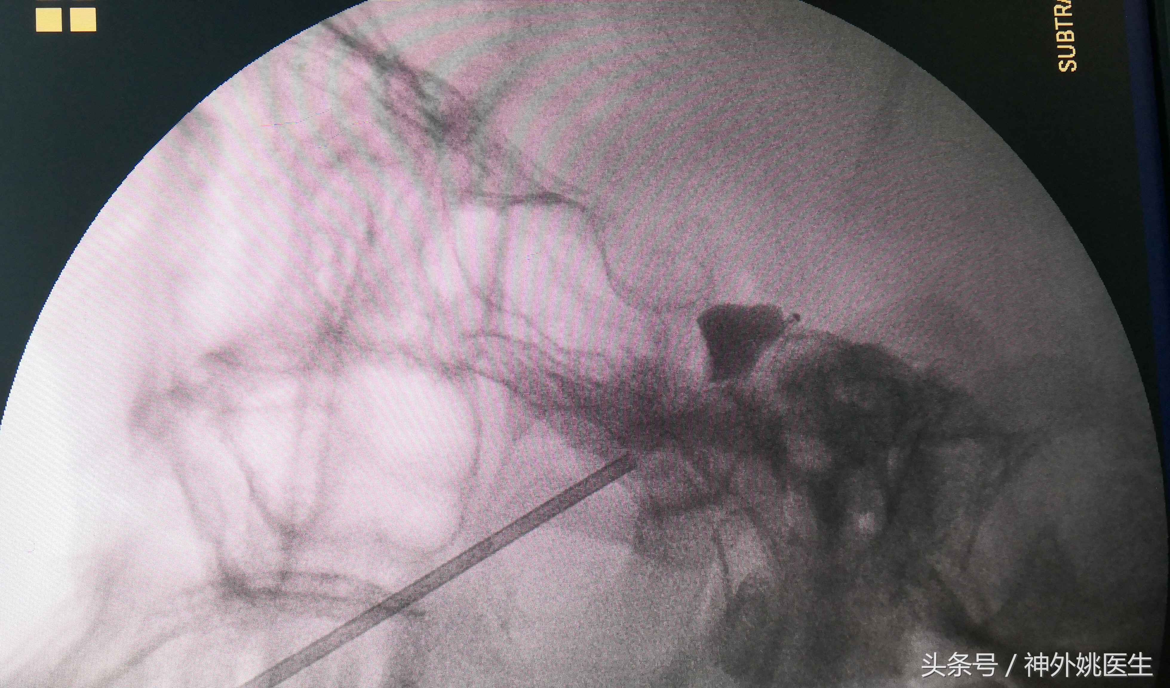 经皮穿刺半月神经节微球囊压迫术,经皮穿刺微球囊压迫术是几级手术