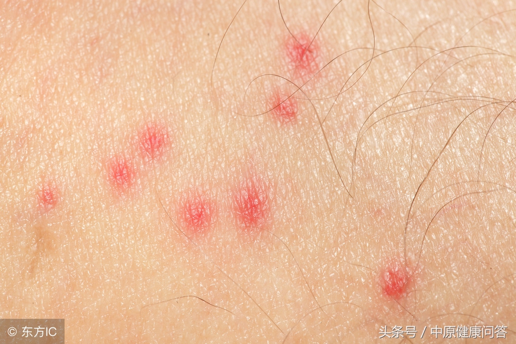 皮肤过敏化验过敏源多少钱,皮肤过敏抽血能查出过敏原吗