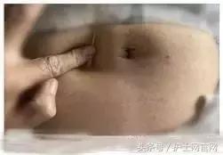 低分子肝素皮下注射后血肿,长期打低分子肝素导致的皮下硬结