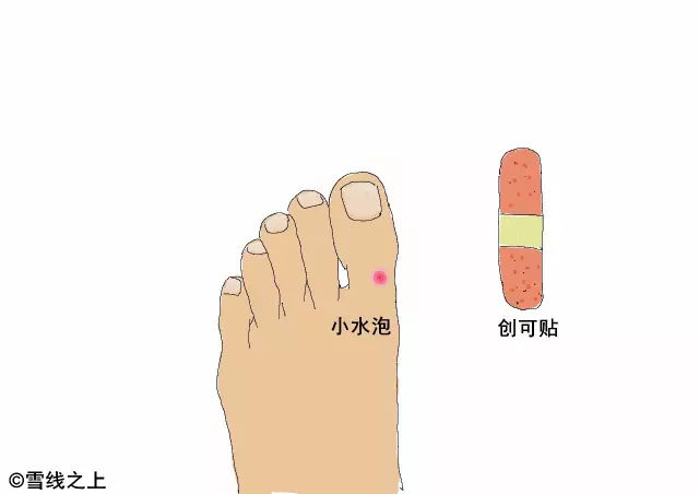 陶冶重庆｜徒步时，如何防治水泡？