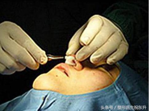 为什么有的人隆鼻成功有的失败,揭秘医生都不会说的隆鼻内幕