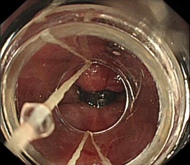 肝硬化中西医结合治疗并发症,肝硬化tips介入手术并发症