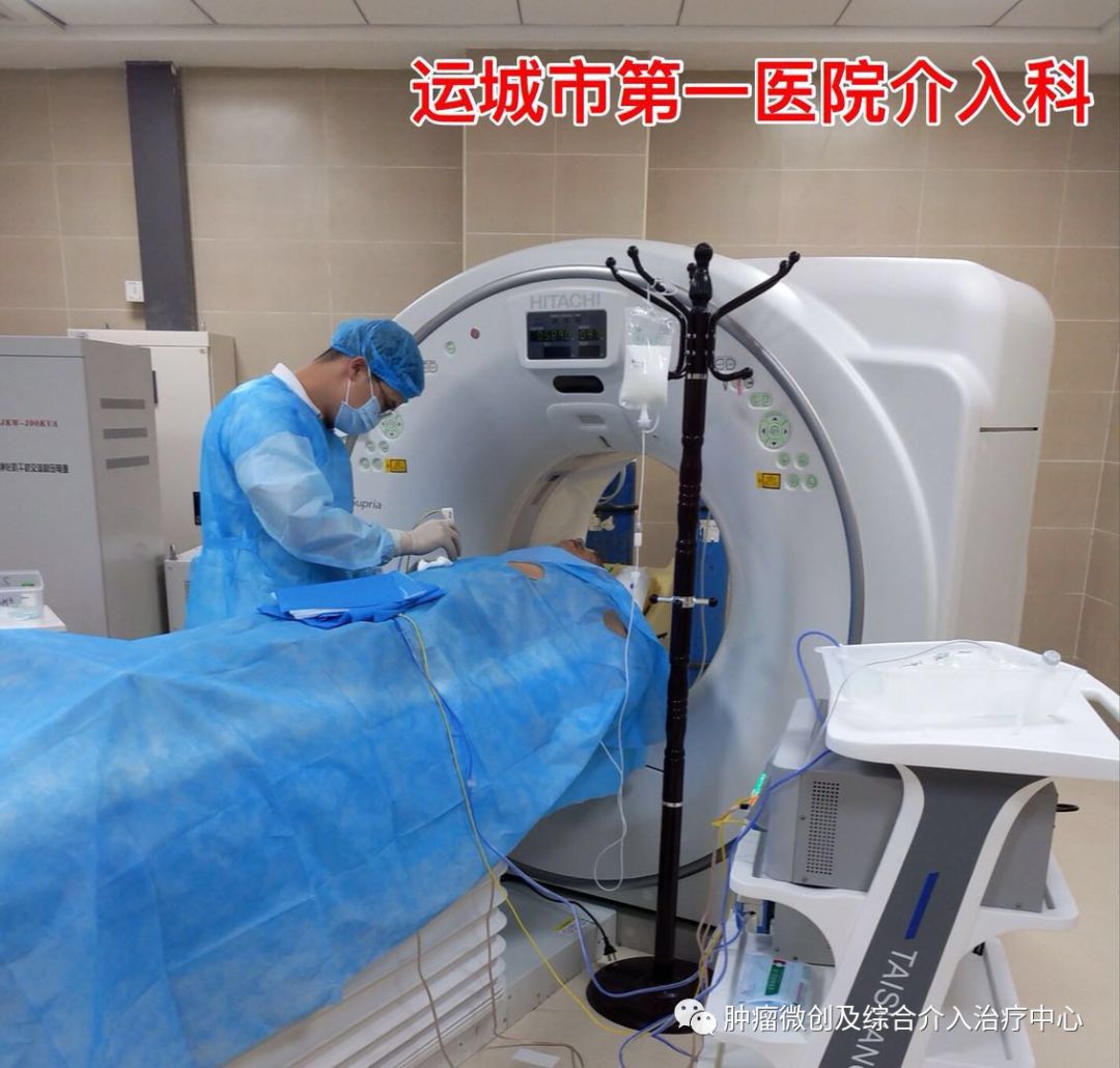 肝癌介入射频消融,肝癌微创消融手术