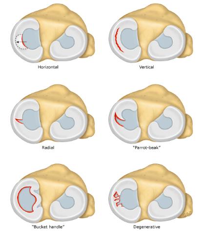 半月板损伤手术大约多少钱,半月板损伤一定要做手术吗