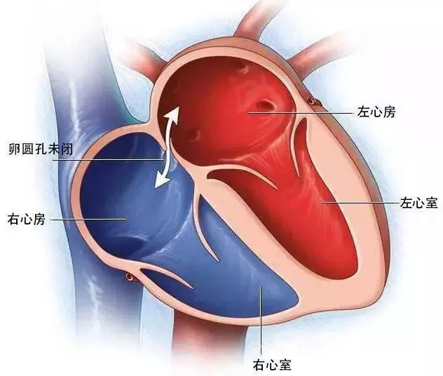 偏头痛要做手术吗,偏头痛心脏手术