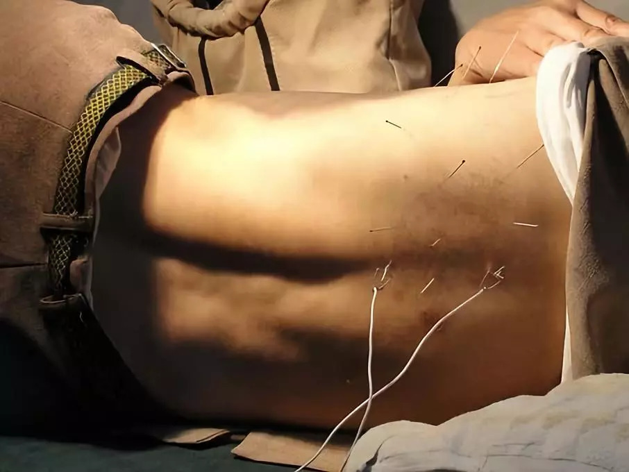 针灸疗法的副作用,针灸治疗的作用小论文