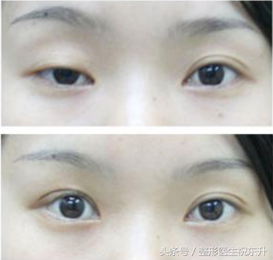 老是感觉上眼皮耷拉怎么回事,老是眼皮跳是什么病