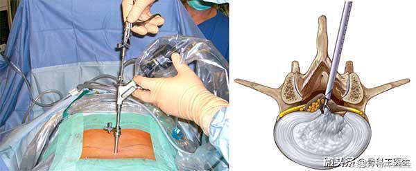 第四期，腰椎间盘突出你最该知道的事！